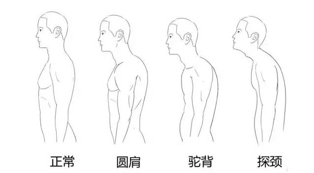 及成因 上交叉综合征主要表现为圆肩(含胸),驼背,头部前倾和翼状肩胛