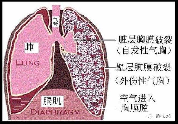 x线诊断要点丨气胸胸膜及胸壁病变