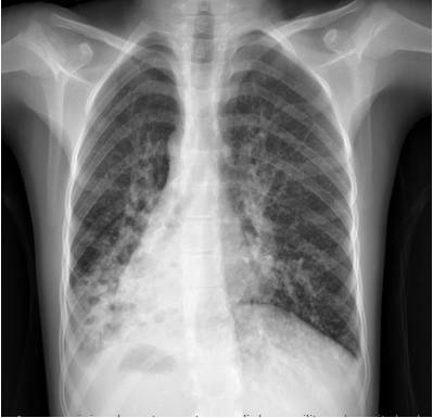 胸片示支气管扩张.胸部ct确定完全性内脏反位和广泛性支气管扩张.
