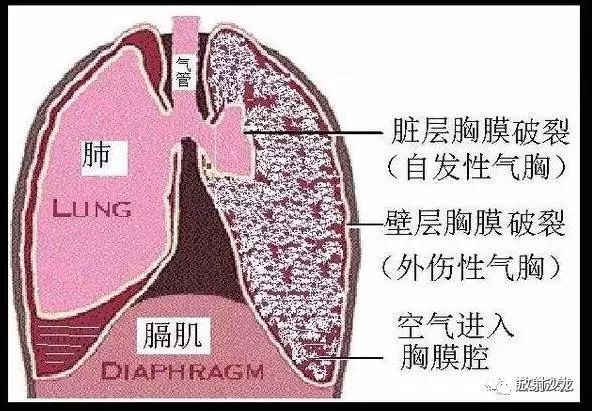 临床上将气胸分为四型: ①闭合性气胸; ②开放性气胸; ③张力性气 