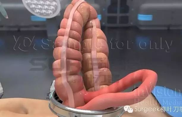 科技 正文 应用腹腔镜操作器械寻找到肠系膜上血管及回结肠血管,解剖
