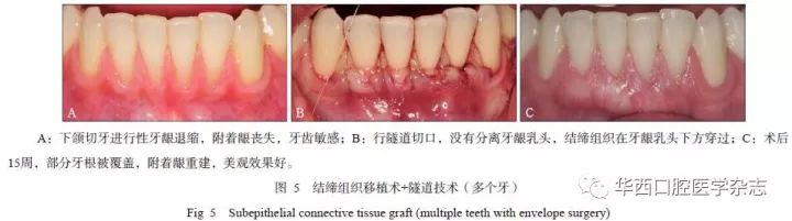 【牙医学堂】牙周膜龈手术的临床应用Ⅰ:自体组织的