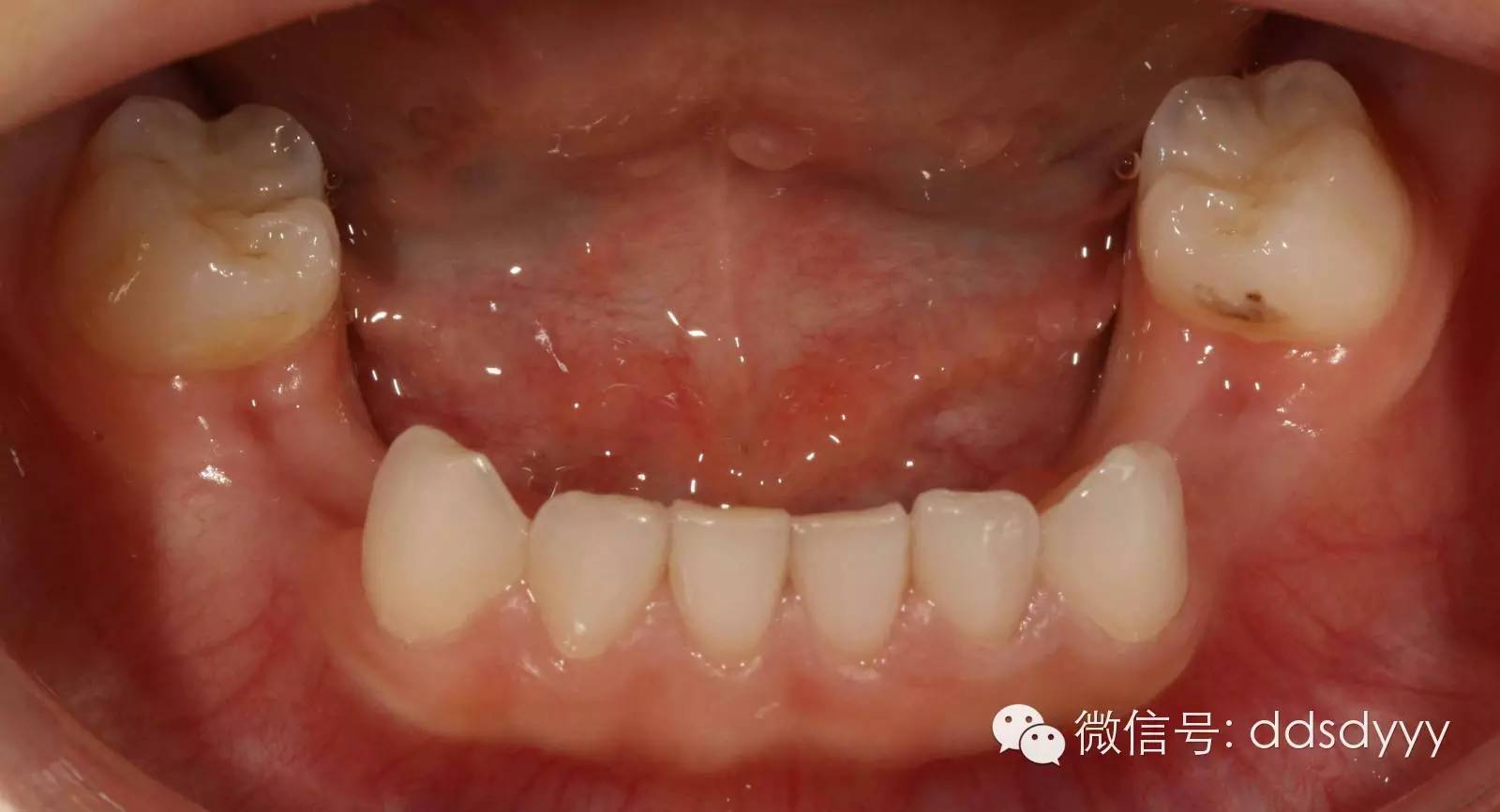 越早看医生越好!12岁前应该处理的20种儿童牙颌畸形