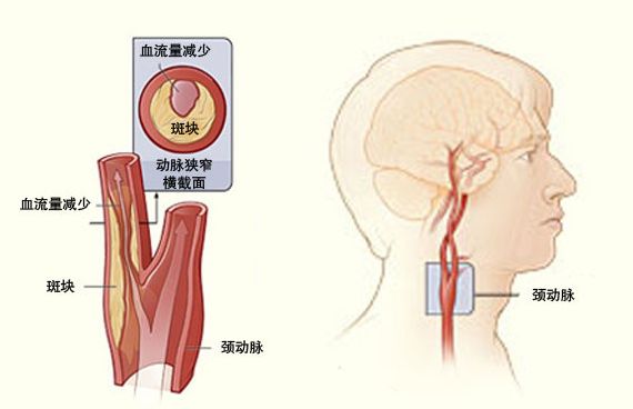 颈动脉支架成形术治颈动脉狭窄有哪些优势?