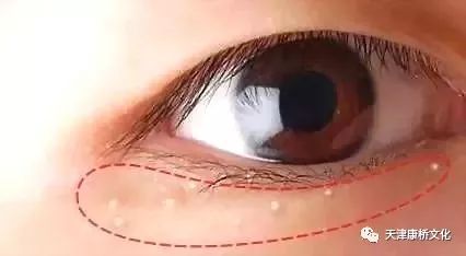 一旦眼睛出现这8种症状,可能是大病征兆
