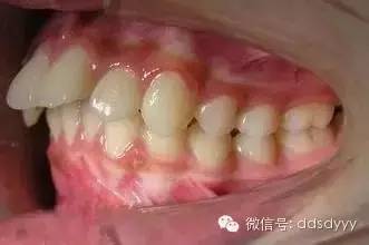 严重的大龅(暴)牙 龅牙患者非常不自信,极大程度的影响了学业和