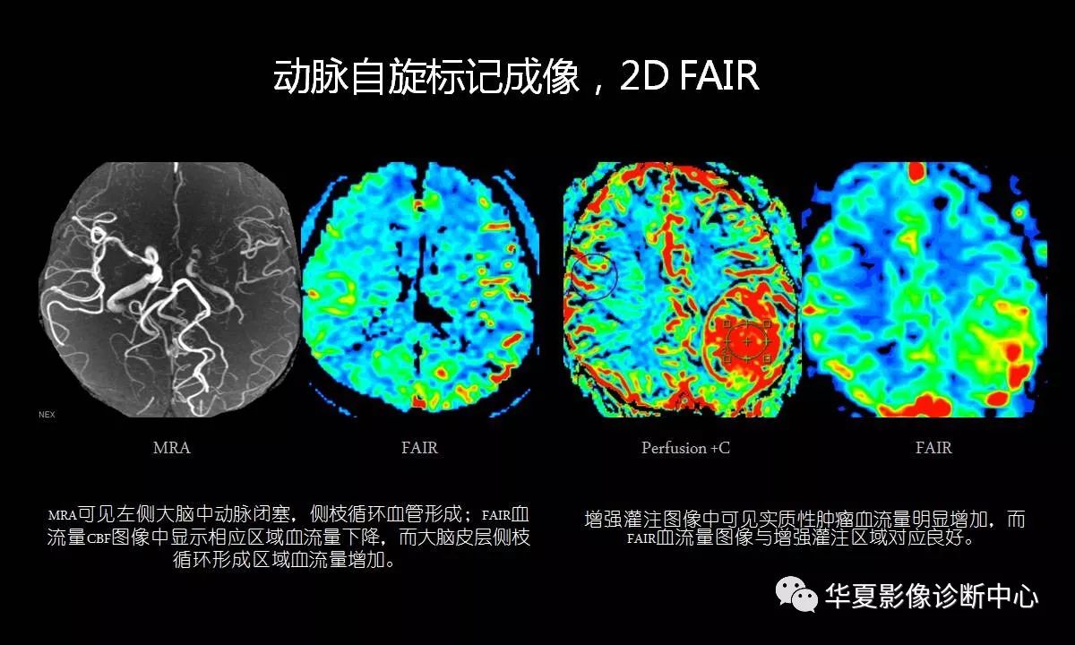 asl脑部灌注的原理及临床应用