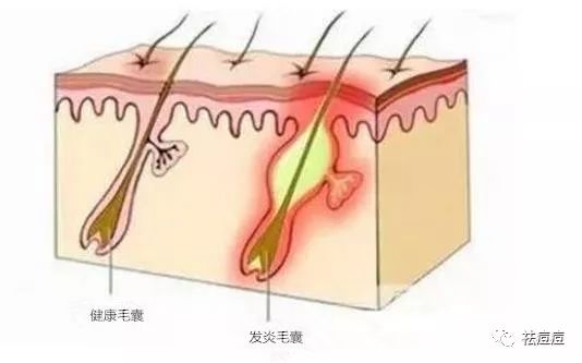 脸上长痘痘是因为什么原因引起的(囊肿性痤疮会自愈吗)(图5)