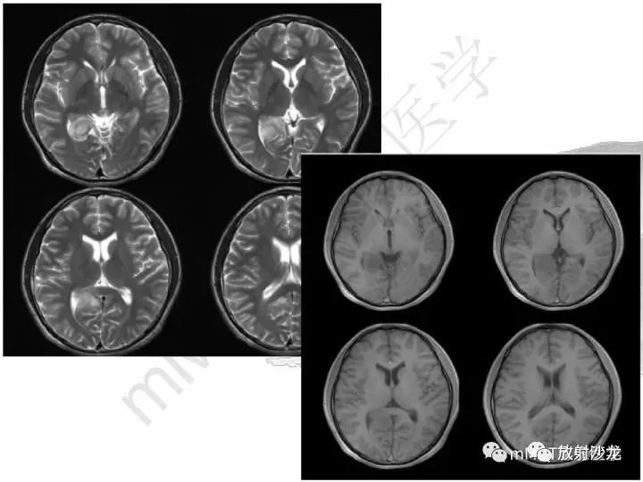 颅内节细胞胶质瘤的mri诊断