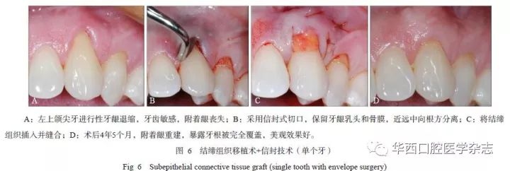 牙医学堂牙周膜龈手术的临床应用Ⅰ自体组织的应用