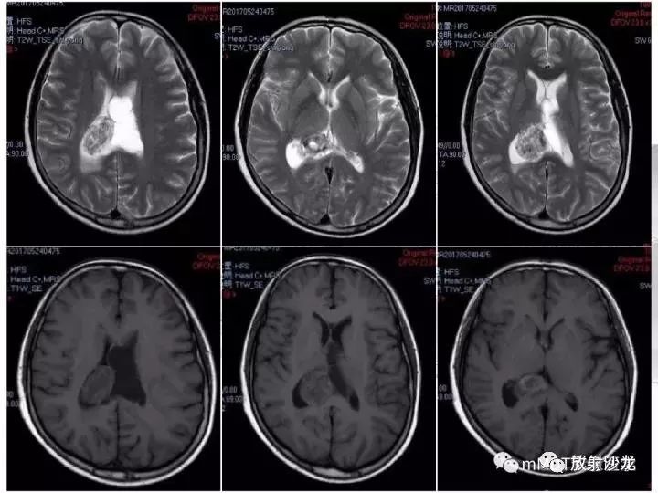 颅内节细胞胶质瘤的mri诊断