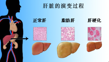 脂肪肝人口_脂肪肝图片真实图片