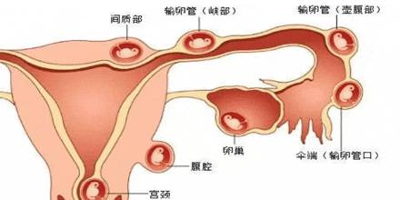 输卵管堵塞会造成宫外孕