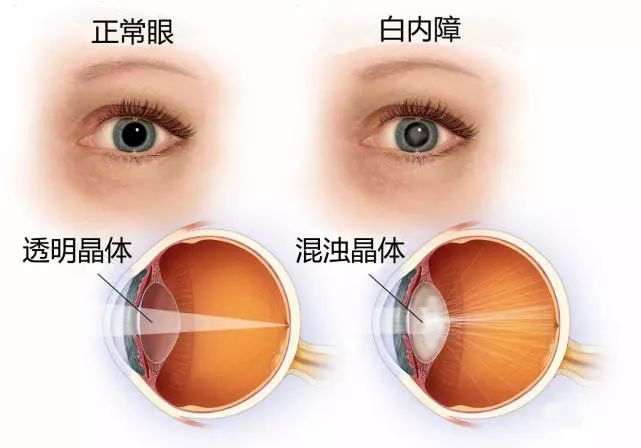 白内障是由于眼睛的晶状体出现混浊而引起的视力下降