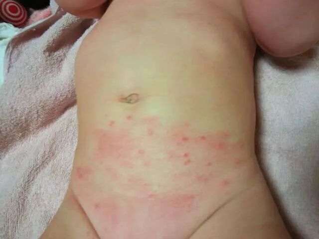 去年冬天,她宝宝刚出生时就曾出现过湿疹和尿布疹问题,没想到今年天气