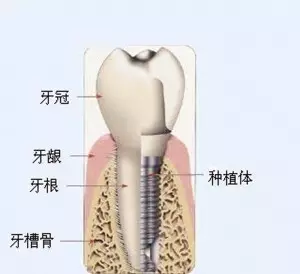 是什么原因导致你的牙槽骨骨量不足?