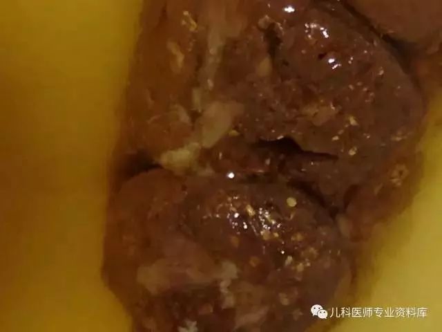 宝宝大便奶瓣,泡沫,黏液到底说明什么?太强大了!(便便