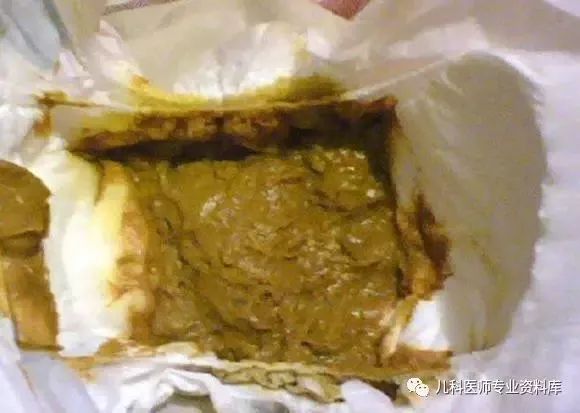 宝宝大便奶瓣,泡沫,黏液到底说明什么?太强大了!