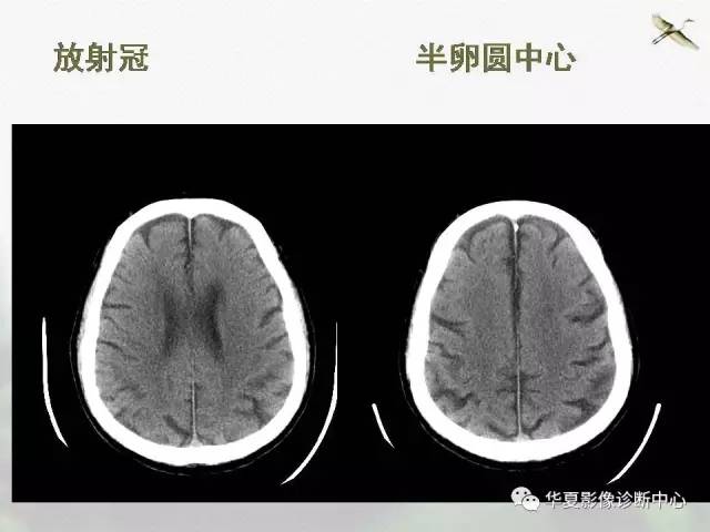 影像基础半卵圆中心与放射冠有什么区别