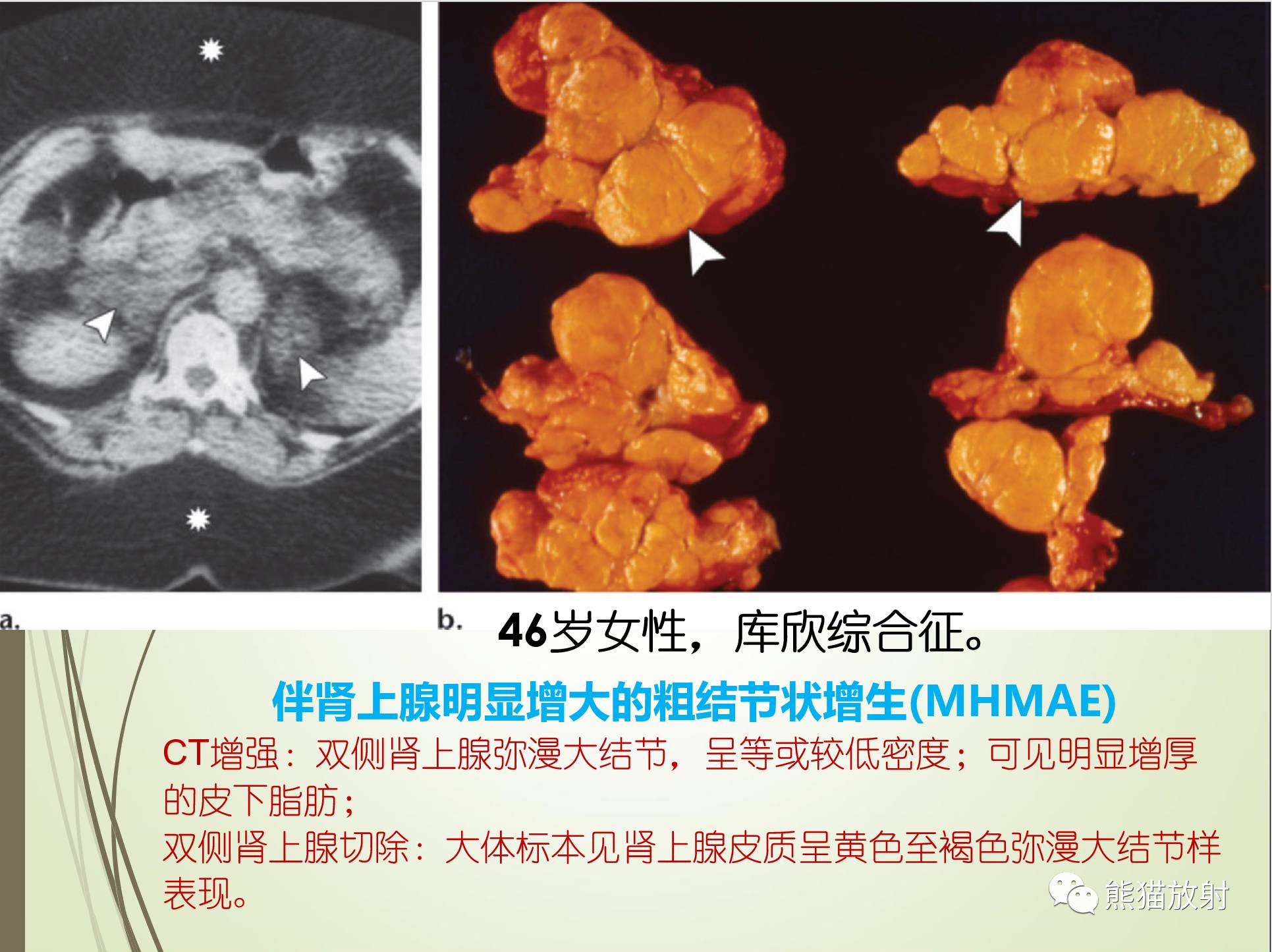 一图秒懂丨非医源性皮质醇增多症之各类肾上腺病变的表现