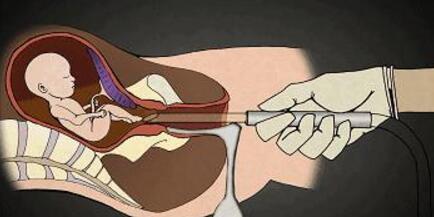 人工流产时胎儿是怎样"打掉"的,看完还敢做吗?