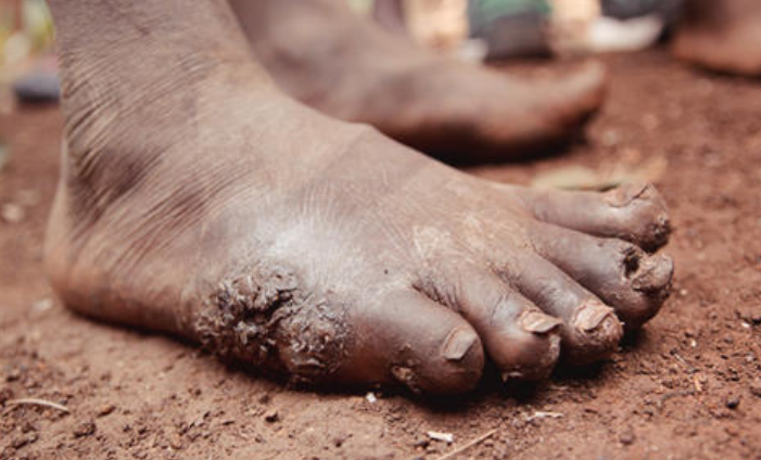 沙蚤在非洲孩子的脚上产卵