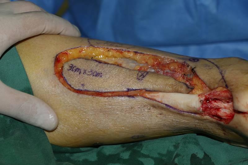 手足外科就诊,查体后诊断为右足跟腱断裂修复术后刀口不愈合,刀口感染