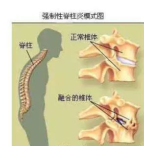 专业分享 如此折磨周杰伦的「强直性脊柱炎,到底是个什么病?