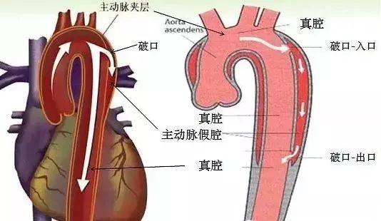 经胸痛中心详细检查,确诊为急性a型主动脉夹层,一旦夹层破裂大出血