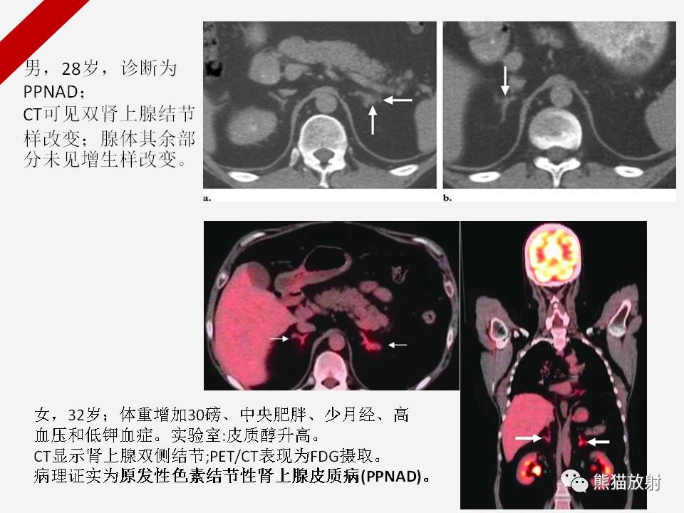 肾上腺功能亢进性病变丨影像表现(ct,mri,pet-ct)