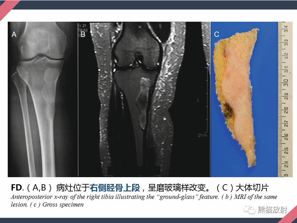 专题骨肿瘤样病变2骨纤维从病理到影像