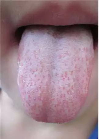 宝宝身体健康信号都藏在舌苔里父母越早知道孩子越少受罪