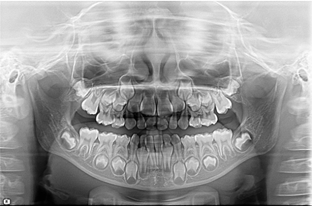 ③全景x光片:拍摄x光片,查看乳牙牙根以及恒牙