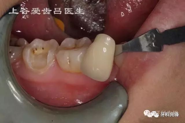 根管治疗后的牙齿一定要做牙冠吗?