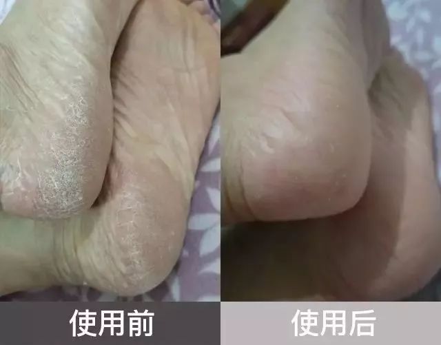 孕妇脚丫子烂了怎么办