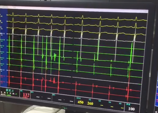 心脏电生理检查
