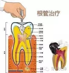 根管治疗是不是就是抽牙神经