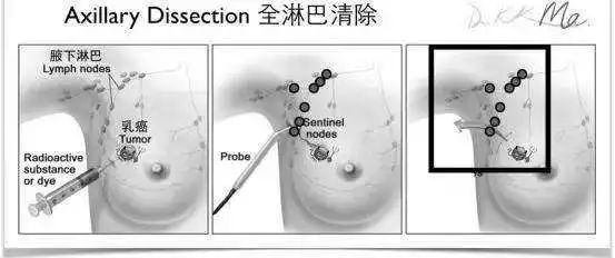 492x563 - 3353282115,4002957792 副乳:腋下淋巴结堵塞!