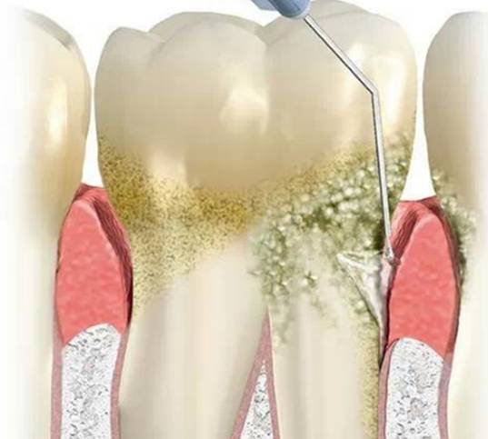 八一八龈下刮治与洗牙的区别