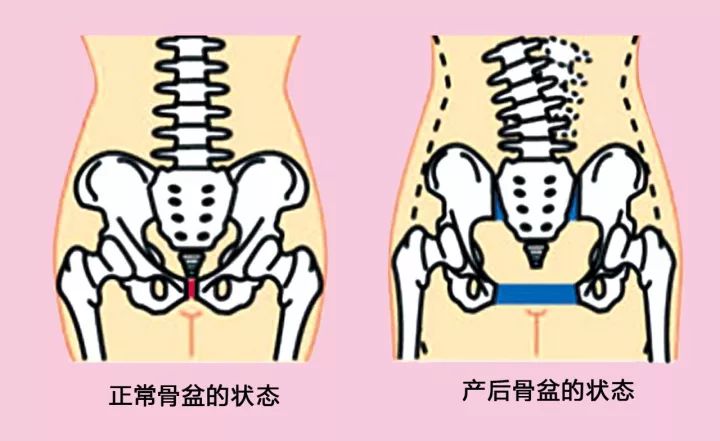 骨盆错位的检测方法 1,俯卧平躺放松时,可明显看出"长短脚".