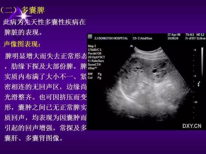 【超声微课堂】脾脏超声诊断