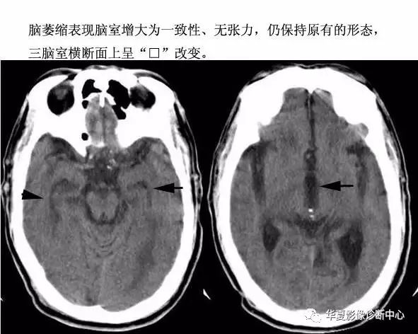 一起看看各种脑积水病因和鉴别诊断吧