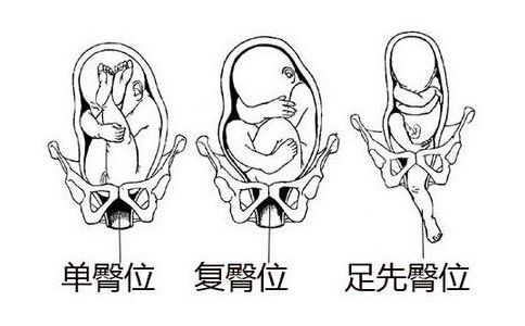 一胎剖腹产,二胎也必须剖?备战二胎的这些误区你知道吗?