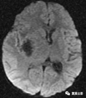 典型脑实质型结核瘤一例