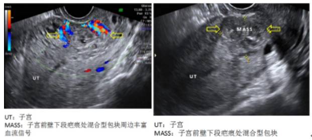 宫外孕的胎儿能顺利生长吗?能要吗?