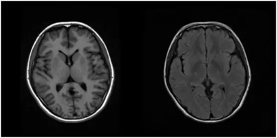 正常人头颅磁共振mr