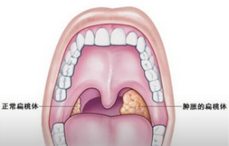 【儿医科普】孩子扁桃体老发炎 割还是不割?