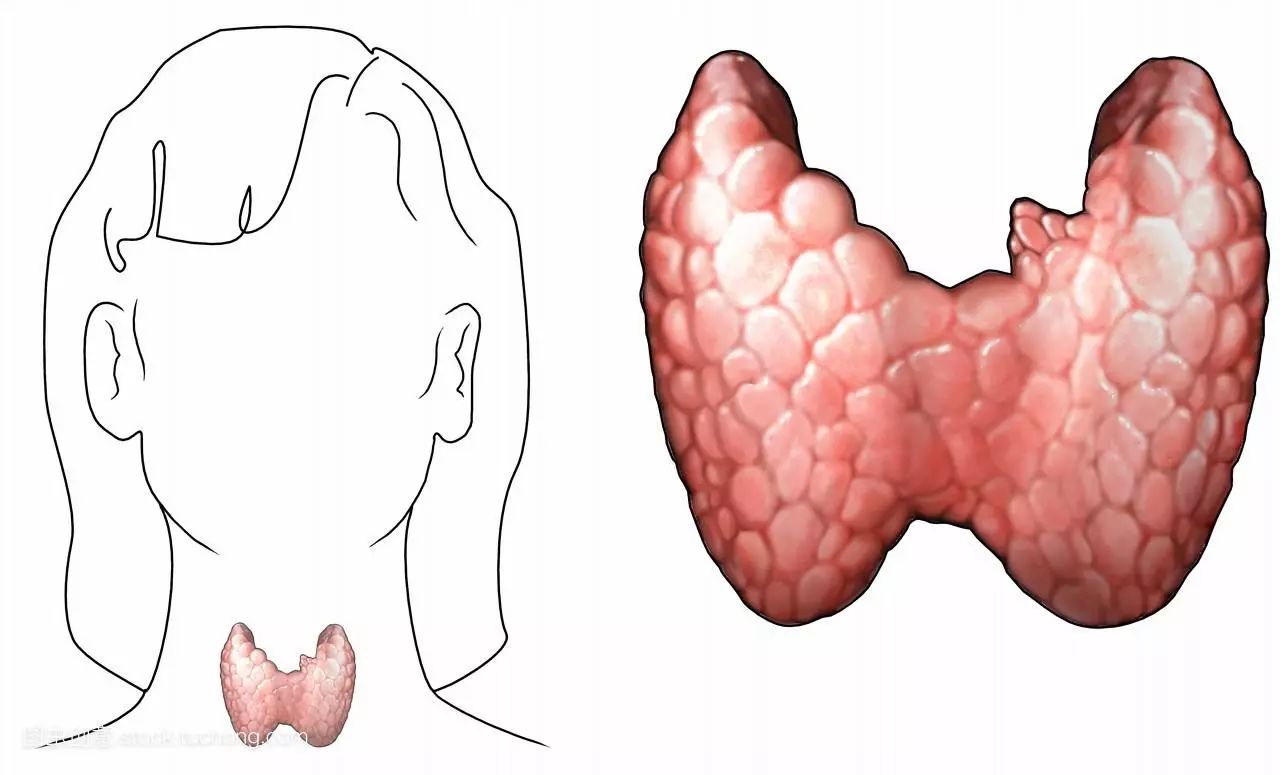 甲状腺是位于喉结下前方内分泌系统腺体,形状像一只蝴蝶,一般触摸不