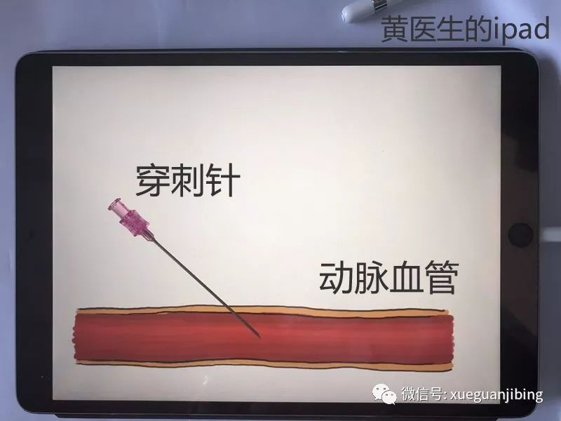 (图1:使用穿刺针穿刺动脉血管)