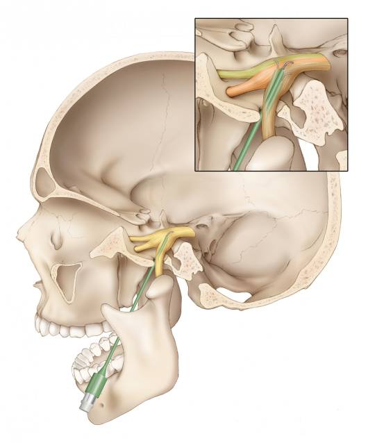 三叉神经痛经皮治疗手术策略与技巧theneurosurgicalatlas全文翻译